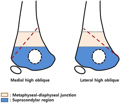 Prevalence and Treatment Outcome of Displaced High-Long Oblique Supracondylar Humeral Fractures in Children